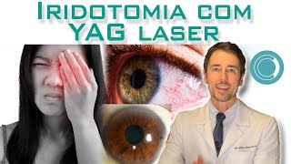 Iridotomia com YAG laser [upl. by Hoppe]