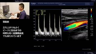 川﨑院長による頸動脈エコー検査動画 高血圧、脂質異常症の増加により頸動脈のプラークを測定することである程度心筋梗塞の発症を予測できたりします 甘木第一クリニック [upl. by Furnary]