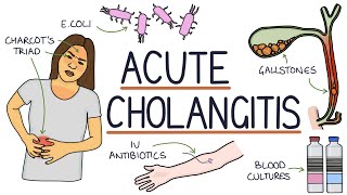 Understanding Acute Cholangitis Ascending Cholangitis [upl. by Dihsar]