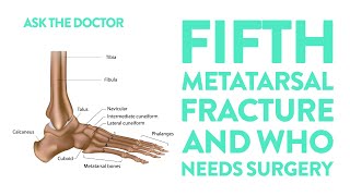 Ask the Doctor Fifth metatarsal fracture and who needs surgery [upl. by Hadlee]