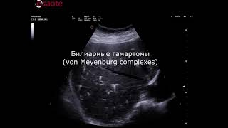 Билиарные гамартомы Biliary Hamartomas von Meyenburg complexes [upl. by Winser475]