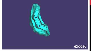 exocadCustomized Subperiosteal Implant for resected maxilla [upl. by Toomay]