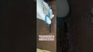 REMOVAL OF STITCHES AFTER SURGERY [upl. by Oiratno]