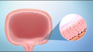 Treatment for Bladder Cancer [upl. by Anin]