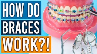 How Do Braces Work [upl. by Vish]