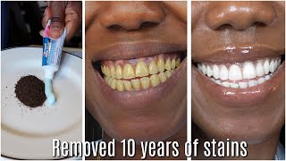 in two minutes remove 10 years of stains from teeth Results will Shock You [upl. by Arded]