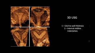 Mullerian duct anomalies  a simplified explanation [upl. by Auburta]