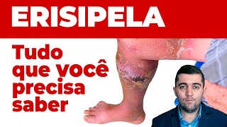 Erispela como curar sinais e sintomas e como prevenir suas complicações Guia completo da doença [upl. by Randee]