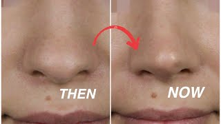 Effective Massage to SLIM YOUR NOSE RESHAPE IT and SHARPEN IT  LETS MAKE OUR NOSE SMALLER [upl. by Anekam]