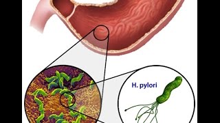 Helicobacter Pylori [upl. by Ahter612]