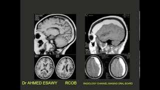 1Radiology Channel Imaging oral board of CNS I imaging [upl. by Zola]