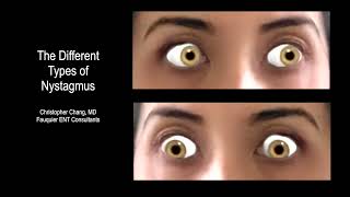 Types of Nystagmus Due to BPPV Vertigo What it Looks Like Which Side amp Which Maneuver [upl. by Aalst]