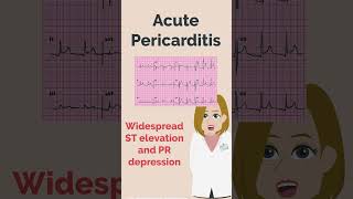 Acute Pericarditis and Myocardial Infarction  PLAB  UKMLA  MedRevisions [upl. by Venterea779]