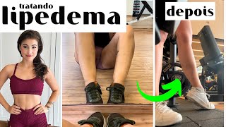 COMO IDENTIFICAR E TRATAR LIPEDEMA [upl. by Ecidna]