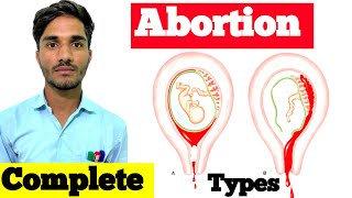 A B O R T I O N  Types Cause Symptoms Diagnosis Treatment  Abortion in Hindi  Types of Abortion [upl. by Tehr]