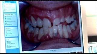 Embarrassing Bodies Dentist  Gum Disease [upl. by Uzzial]