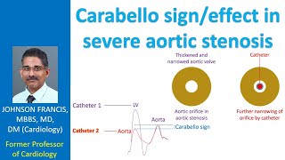 What is Carabello signeffect in severe aortic stenosis [upl. by Lela19]