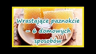 Wrastające paznokcie – 6 domowych sposobów  Zdrowe życie [upl. by Gudren755]