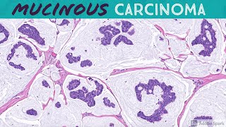 Primary Cutaneous Mucinous Carcinoma amp Endocrine MucinProducing Sweat Gland Carcinoma [upl. by Candida]