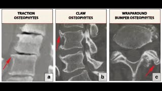 Osteophytes Bone Spurs  Definition causes Symptoms Diagnosis Treatment [upl. by Nosnibor]