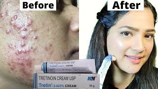 Acne Treatment At Home  TretinoinRetino A 0025cream [upl. by Enahpad]