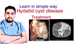 Hydatid cyst disease of liverTreatment [upl. by Nosnevets]