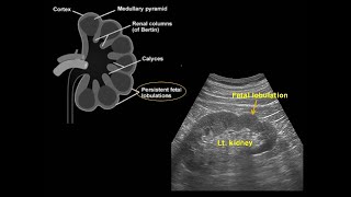 Fetal lobulation of kidney 신장의 태아 분엽 [upl. by Ainegul272]