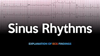 Sinus Rhythm ECG Explained [upl. by Slinkman901]