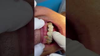 Enfermedades dentales Vs Tiempo 😥 shorts viral dientesblancos tendencias dentist [upl. by Annayd]