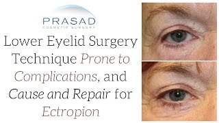 The Causes and Repair of Ectropion from Previous Eyelid Surgery and How its Avoided [upl. by Engdahl474]