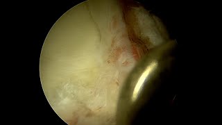 Previously Repaired Labrum with Multiplanar Grade 3 Complexity [upl. by Leoline703]