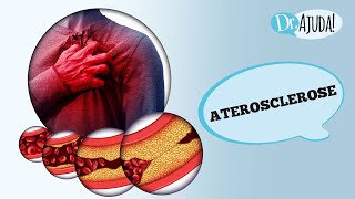 ATEROSCLEROSE O QUE É CAUSAS SINTOMAS FATORES DE RISCO TRATAMENTO E PREVENÇÃO [upl. by Assinna]