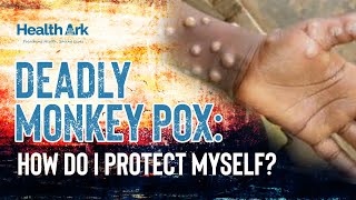 Monkeypox virus Prevention and treatment options mpox monkeypoxtreatment monkeypoxprevention [upl. by Akiehs]