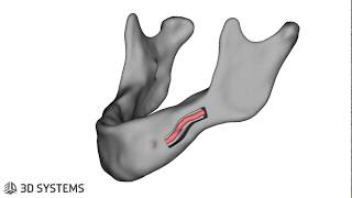 IAN LateralizationTransposition Osteotomy VSP by 3D Systems [upl. by Leese]