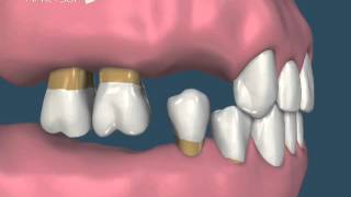 Consequências da perda Dentária [upl. by Blumenfeld893]