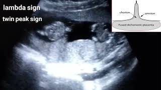 Dichorionic diamniotic twin pregnancylambda sign [upl. by Peregrine]