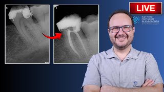 Endo Tx of 🦷37 with Irreversible Pulpitis amp Condensing Osteitis ▶️ Part 2  CASE164 [upl. by Thekla]