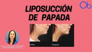 Liposucción de papada [upl. by Laehpar]