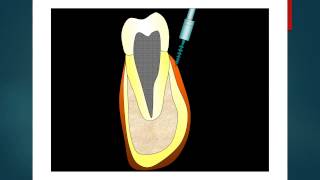 How to put a Miniscrew Lower ArchOrthodontics [upl. by Annaik566]