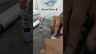 Prepare Perfect blood smear Blood film preparation Blood smear labor hematology laboratory [upl. by Aelyk]