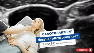 Carotid artery Doppler ultrasound test Accurate examination to perform a basic ultrasound carotid [upl. by Donaghue448]