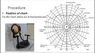 perimetry viva questions [upl. by Atnahc831]