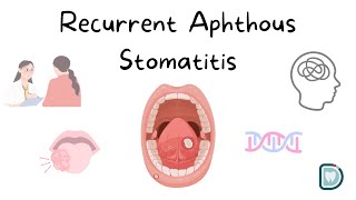 Understanding Recurrent Aphthous Stomatitis RAS or Oral Aphthous Ulcers [upl. by Tnarb892]