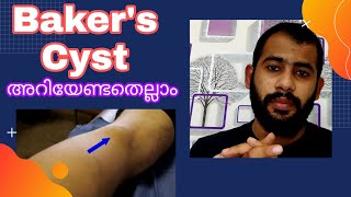 Bakers Cyst MalayalamSymptoms causesTreatment [upl. by Alexander]