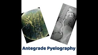 antegrade Pyelography [upl. by Rogers]