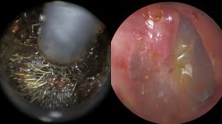 142  Painful 4 Year Old Rock Solid Ear Wax Impacted Against Eardrum Removed Using WAXscope®️ [upl. by Gerhard551]