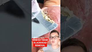 Crazy EXTREME BLACKHEAD REMOVAL  Would You Try This shorts [upl. by Mani]