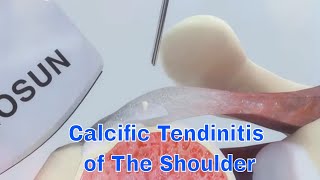 Get Relief From Calcific Tendinitis Of The Shoulder With Surgery And Injection Treatment [upl. by Salli]