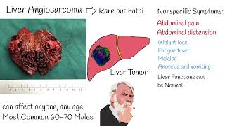 Liver angiosarcoma  Symptoms and treatment liver angiosarcoma prognosis life expectancy [upl. by Em]