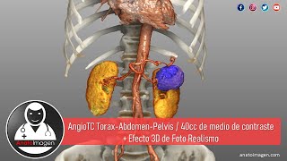 Angio Tomografía de Tórax Abdomen y Pelvis  Efecto Foto Realista [upl. by Welcher]